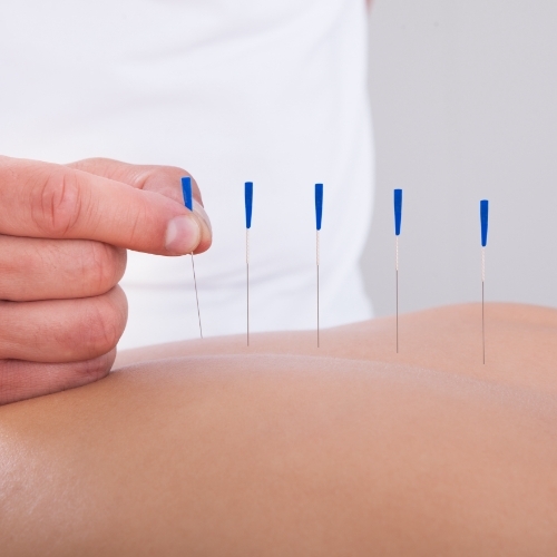 Dry-Needling-PhysioKC-Physical-Therapy-Leawood-KS